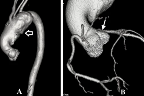 Hy hữu: Bệnh nhân phình động mạch chủ cực đại tới nửa gang tay, được cứu sống thần kỳ