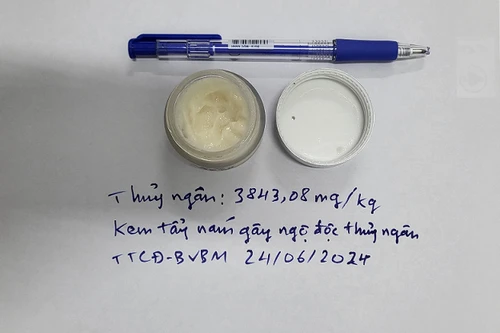 Cô gái nguy kịch vì dùng 5 hộp kem chống nám chứa hàm lượng thủy ngân vượt ngưỡng 4.000 lần