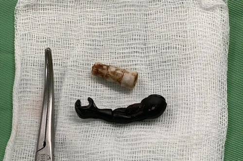 Gắp ra cánh tay đồ chơi siêu nhân bằng nhựa, đầu bút từ âm đạo bé 5 tuổi