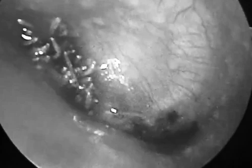 Kinh hãi: Giòi làm tổ lúc nhúc trong tai nam bệnh nhân