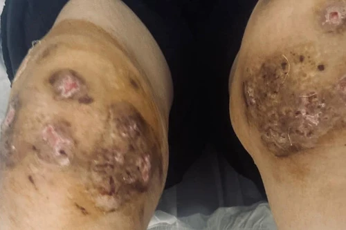 Trả giá đắt vì chữa thấp khớp bằng cách cho ong đốt chi chít vào chân