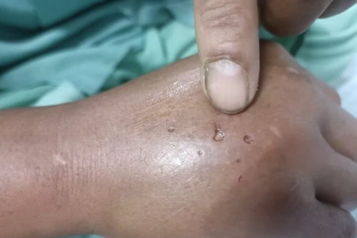 Truyền 10 lọ huyết thanh cứu hai chị em sinh đôi bị rắn hổ mang cắn