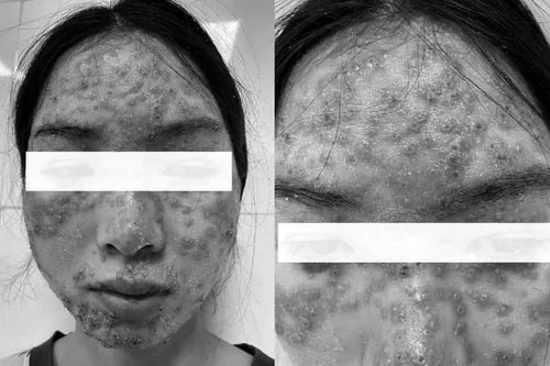 Nhiều cô gái trẻ phải nhập viện do đắp mặt, bôi kem detox