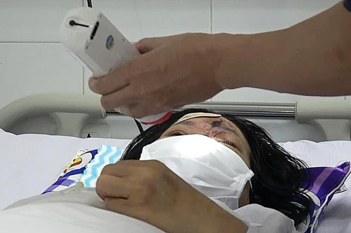 Co giật, mù mắt chỉ sau 15 phút tiêm filler nắn sống mũi ở Hà Nội