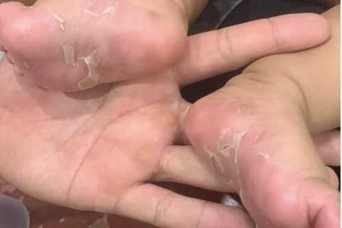 Bố, mẹ và bé trai sơ sinh 3 tháng tuổi cùng mắc bệnh giang mai