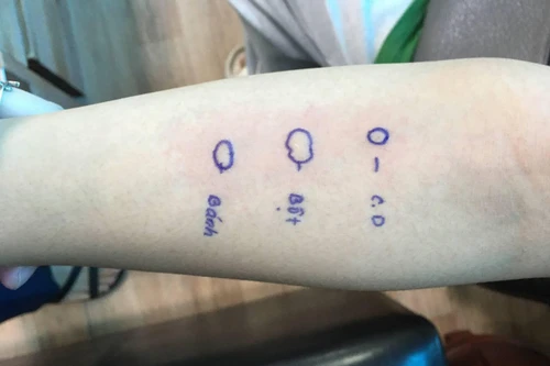 Ăn một chiếc bánh mỳ trước khi vào phòng tập thể dục, cô gái trẻ ngất xỉu, dị ứng toàn thân