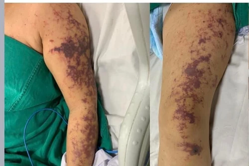 Một phụ nữ ở Hà Nội nhập viện cấp cứu sau 2 ngày ăn lòng lợn