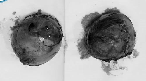 Lần đầu tiên có bệnh nhi bị u tuyến thượng thận hai bên – cực hiếm gặp trên thế giới