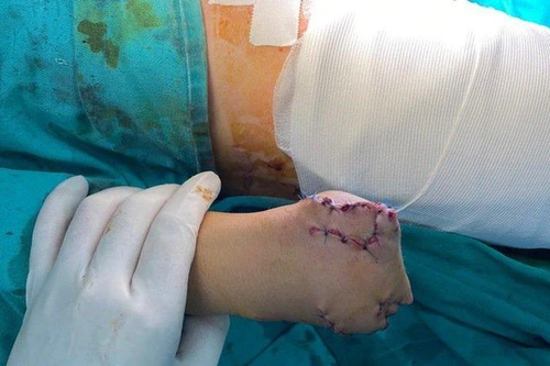 Phục hồi mỏm cụt cho nữ công nhân bị máy cuốn cụt 1/3 cánh tay ở Thường Tín
