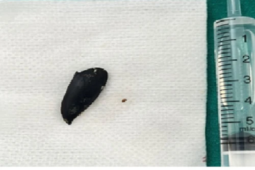 Ho suốt 3 tháng không khỏi, nhập viện mới phát hiện có hạt hồng xiêm trong phổi