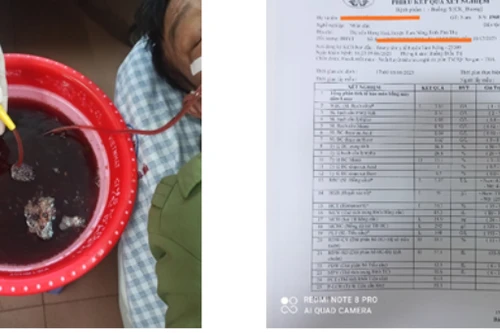 Mỗi ngày uống nửa lít rượu, người đàn ông 8 lần giãn vỡ tĩnh mạch, nhập viện vì nôn ra 1 lít máu...