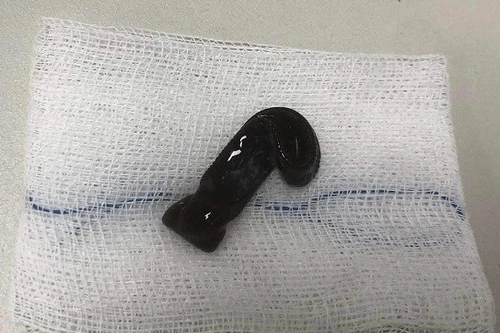 Bác sĩ giật mình khi nội soi nhìn rõ con đỉa lớn đang di chuyển trong mũi bệnh nhân