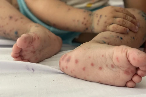 Số mắc tay chân miệng ở Hà Nội tăng 3 tuần liên tiếp, 26 quận huyện đã có bệnh nhân