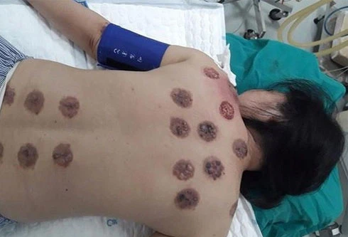 Đi giác hơi, một người bị bỏng cồn nặng phải nhập viện