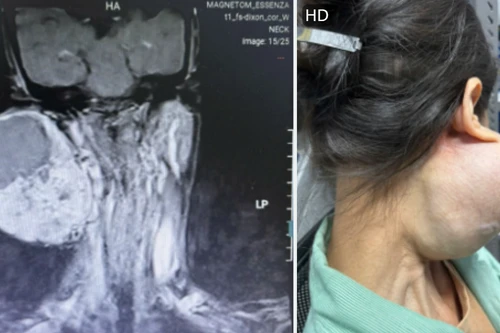 Người phụ nữ suýt mất mạng vì đeo khối u khổng lồ trên mặt suốt 14 năm