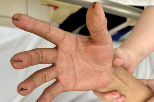 Bé trai 10 tuổi tử vong do bị dùng dao lam rạch chảy máu để thải độc chữa bệnh