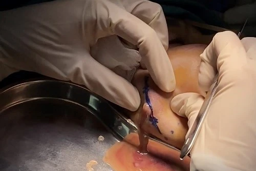 Cô gái bị áp xe, hoại tử má do tiêm filler thường xuyên để làm căng bóng da mặt