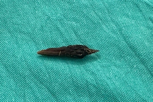 Người phụ nữ bị thủng ruột do nuốt hạt khi ăn yến chưng cùng táo đỏ