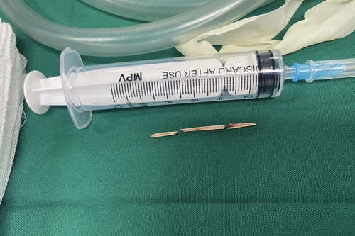 Hy hữu: Người phụ nữ thủng dạ dày vì nuốt que tăm mà… không nhớ