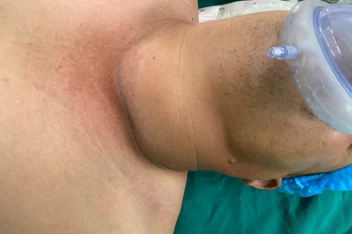 Chủ quan vì nghĩ u tuyến giáp lành tính không cần mổ, nam bệnh nhân diễn biến nặng