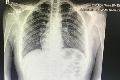 Hy hữu: Nam thanh niên Hà Nội có phủ tạng đảo ngược hoàn toàn, tim nằm bên phải