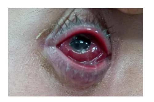 Nam thanh niên sưng mắt, mưng mủ phù nề chữa mãi không khỏi, hóa ra bị… bệnh đường tình dục