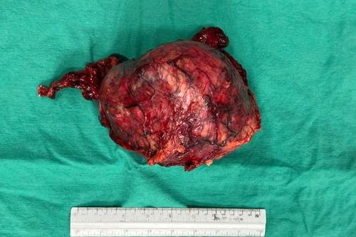 Người phụ nữ bất ngờ phát hiện có khối u thận khổng lồ