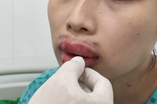 Nhập viện vì biến chứng do đi thẩm mỹ làm đẹp “cấp tốc” trước Tết