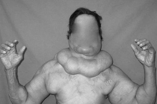 Vòng ngực, bụng tăng bất thường, người phụ nữ được phát hiện căn bệnh u mỡ cực kỳ hiếm gặp