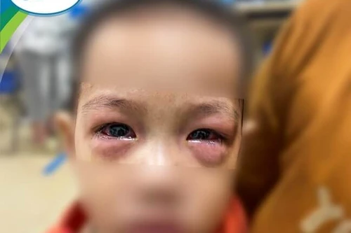 Dịch đau mắt đỏ ở Hà Nội gia tăng nhanh, 10-20% trẻ gặp biến chứng nặng