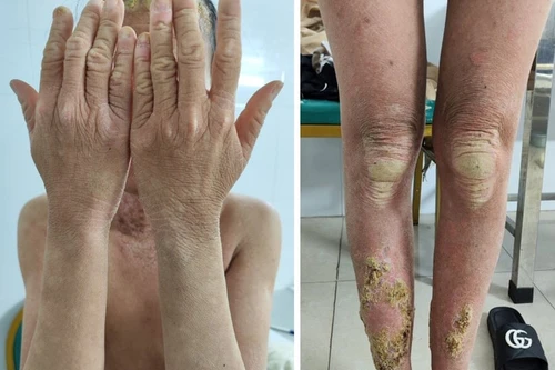 Hiếm gặp: Người phụ nữ mắc bệnh khắp người như mọc "rêu”, thế giới mới có khoảng 100 ca