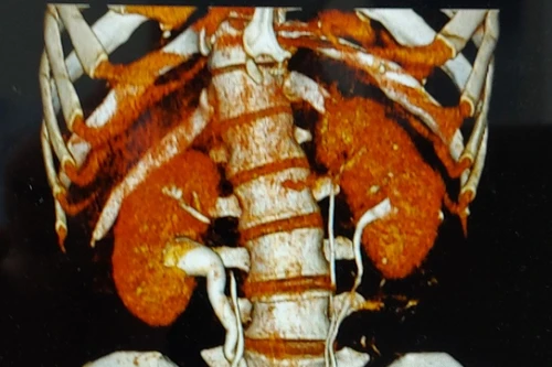 Độc lạ: Người đàn ông ở Hà Nội có tới 4 quả thận