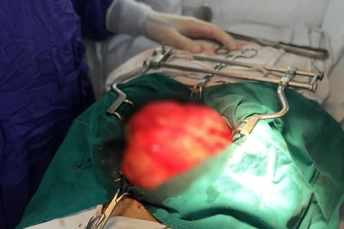 Một người ở Hà Nội mắc ung thư hiếm gặp, cắt bỏ 2 lần lại tái phát u “khủng”