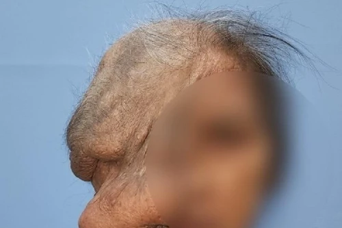 Phẫu thuật cho cụ bà bị khối u quá lớn che hết khuôn mặt, ăn vào mắt, xương sọ