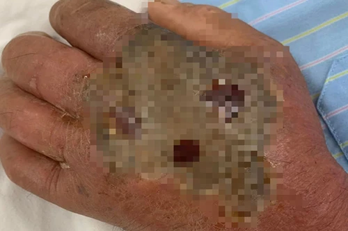 Vào “mùa rắn cắn”, một trường hợp hoại tử bàn tay do tự điều trị