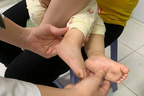 Bệnh viện Nhi Trung ương khuyến cáo 3 dấu hiệu trẻ mắc tay chân miệng cần nhập viện