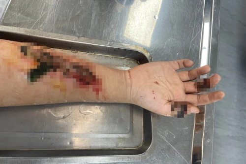 Đắp lá chữa vết thương do mảnh kính đâm trong dịp nghỉ lễ, nam thanh niên suýt hoại tử cánh tay