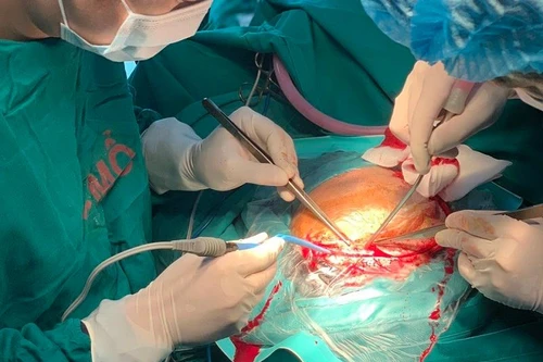 Ghép sọ bằng tấm titanium tạo hình 3D cho một nam sinh ở Hà Nội