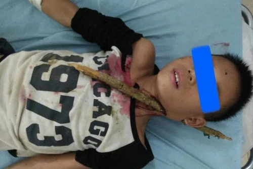 Bé trai bị thân cây gỗ đâm xuyên cổ may mắn được cứu sống