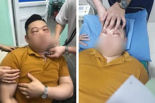 Nam thanh niên bị sốc phản vệ nặng chỉ vì thái một củ hành