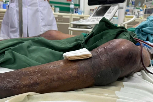 Chỉ từ vết gai đâm, người đàn ông nhập viện với hai chân tím đen, đang thập tử nhất sinh