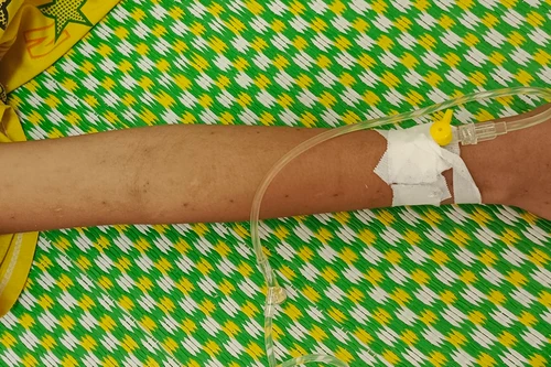 Bé 11 tuổi nhập viện vì chữa bệnh bằng cách rạch tay để nặn máu độc ra ngoài