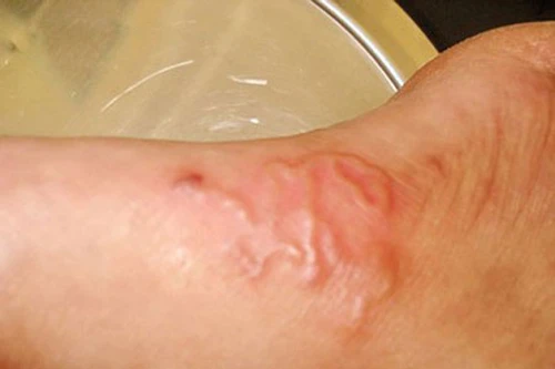 Ăn hải sản sống nguy cơ nhiễm giun lươn