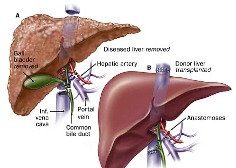 Sàng lọc giúp tăng tỉ lệ sống sót do ung thư gan