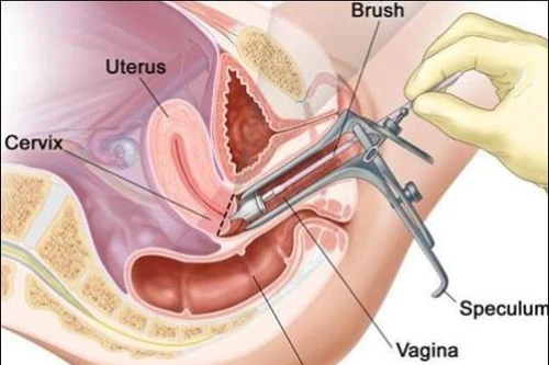 Dấu hiệu cảnh báo ung thư cổ tử cung