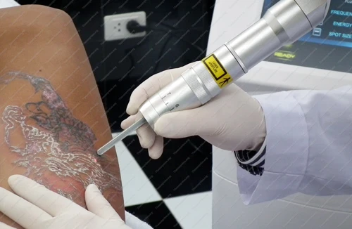 Nạn nhân của “trang điểm vĩnh viễn”