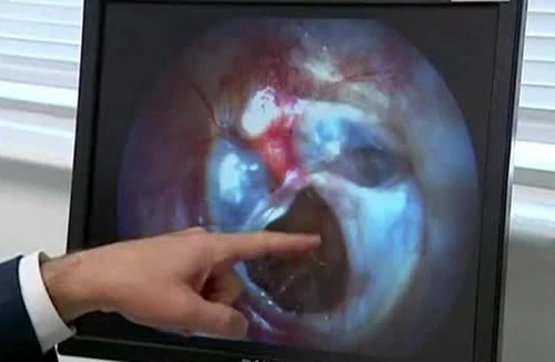 “Vá” màng nhĩ bằng tơ tằm 