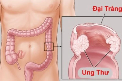 Tìm ra 5 gene liên quan đến ung thư đại tràng