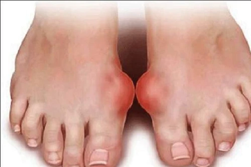 Bệnh gút có thể làm tăng nguy cơ tiểu đường