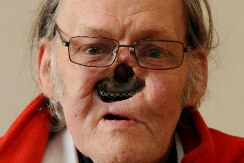 Gương mặt kinh dị sau phẫu thuật